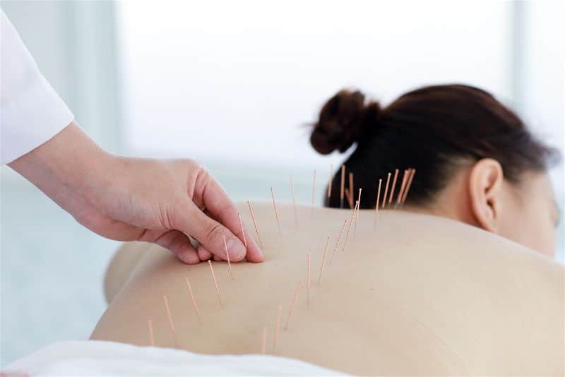 Agulhas de acupuntura nas costas de uma mulher